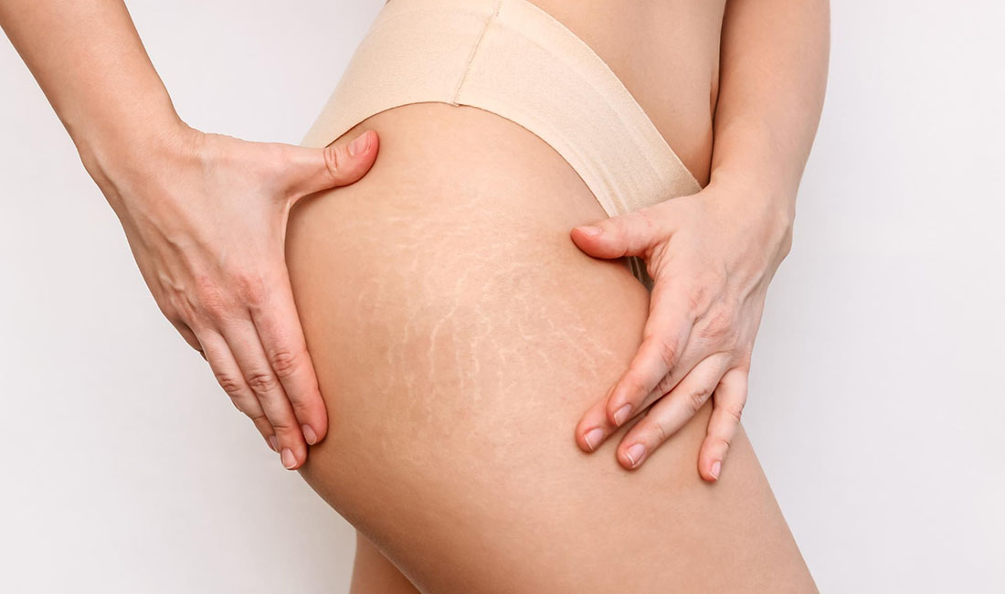 rozstępy na skórze